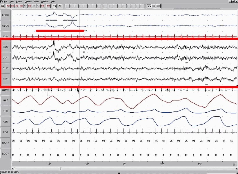 An example labelled as REM-sleep EEG in its source