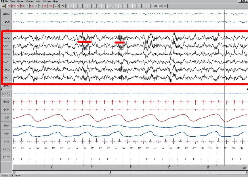 An example labelled as stage-two sleep EEG